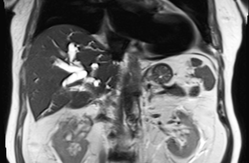 CT scan of patient with perihilar cholangiocarcinoma.